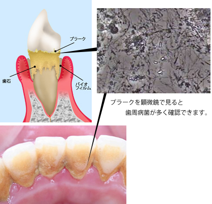 ひかりのテラス歯科クリニック_歯周病治療